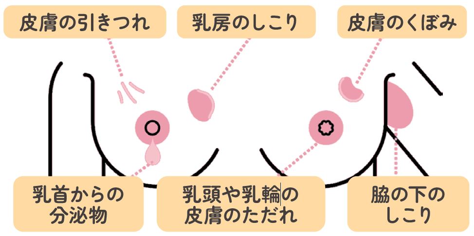 【乳房を見るときや触るときに注意すべき変化】